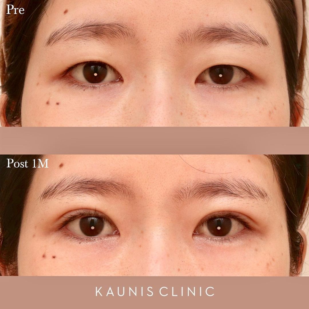 KAUNIS CLINICの二重埋没症例